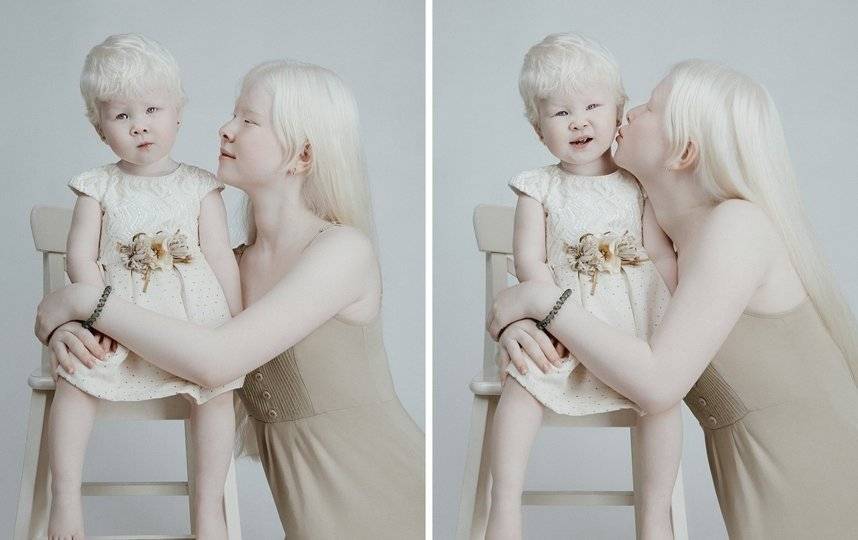 24 факта, которые вы не знали об альбинизме :: инфониак