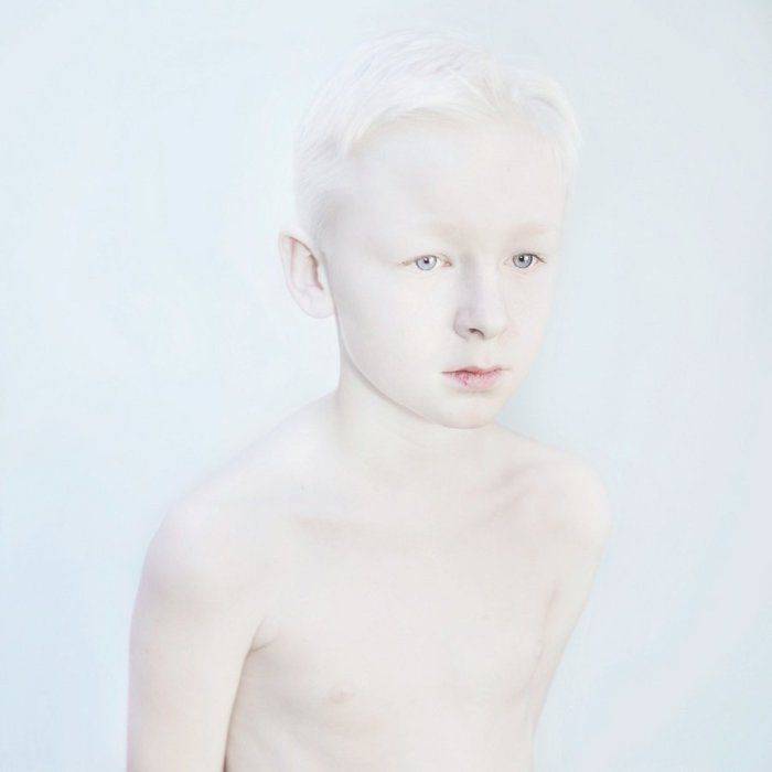 Люди-альбиносы – почему рождаются и как живут дети с недостатком меланина?