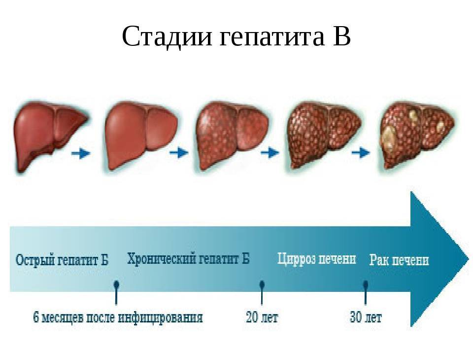 Печеночная энцефалопатия