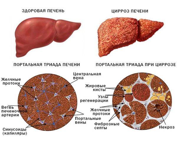 Какие симтомы цирроза печени у собак?