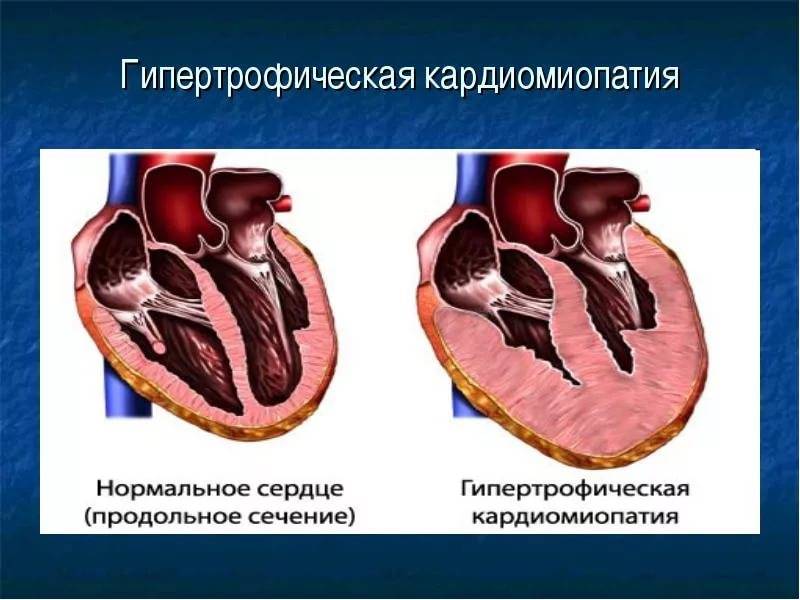 Гипертрофическая кардиомиопатия кошек (гкмп) - симптомы лечение заболеваний сердечной мышцы у кошек в москве. ветеринарная клиника "зоостатус"