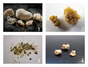 Камни в почках (нефролитиаз): симптомы и лечение – напоправку – напоправку