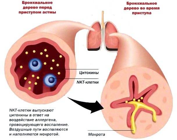 Бронхиальная астма у детей и взрослых - причины, симптомы, диагностика, лечения