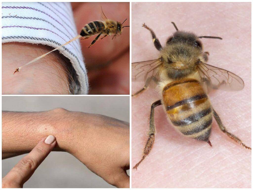 Что делать, если укусила оса или пчела? правила первой помощи