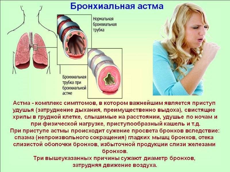 Аллергическая астма | компетентно о здоровье на ilive